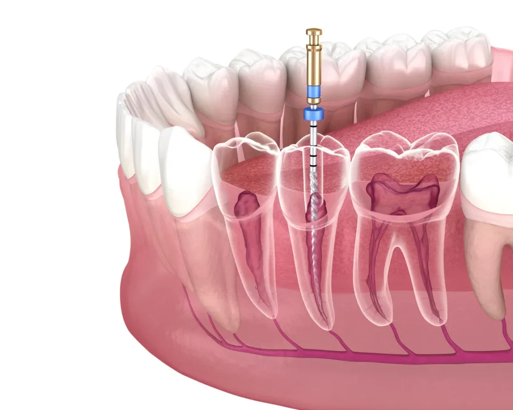 Devitalizzazione Dente a Pinerolo