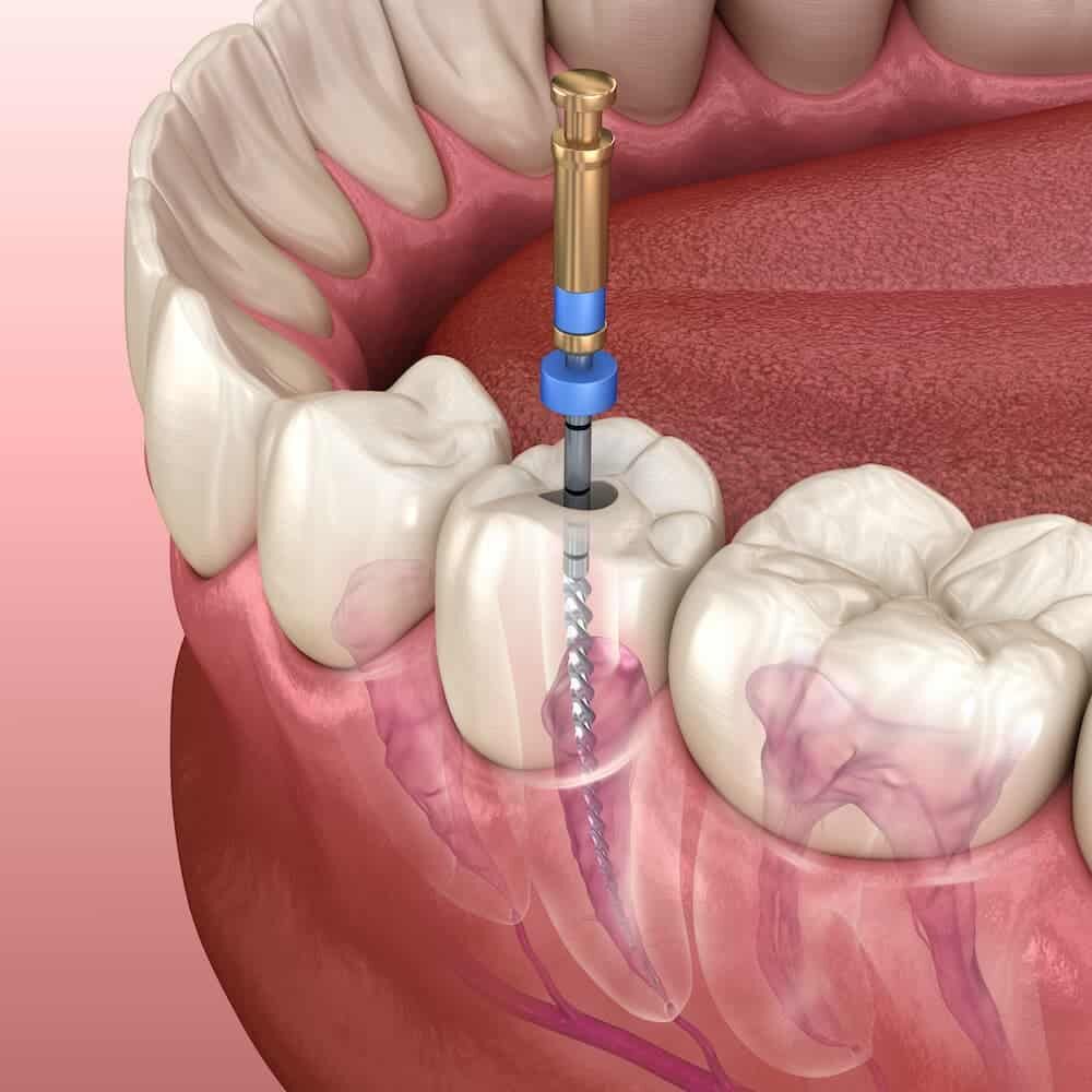 Devitalizzazione Dente a Pinerolo